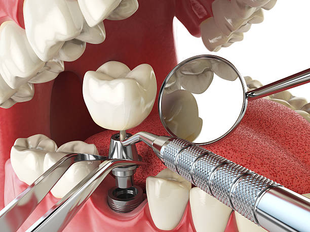 Best Emergency Dentist for Knocked-Out Tooth in Bonadelle Ranchos, CA